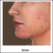 Amount of vitamin a in accutane