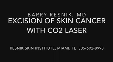 Excision of a Squamous Cell Carcinoma with CO2 laser